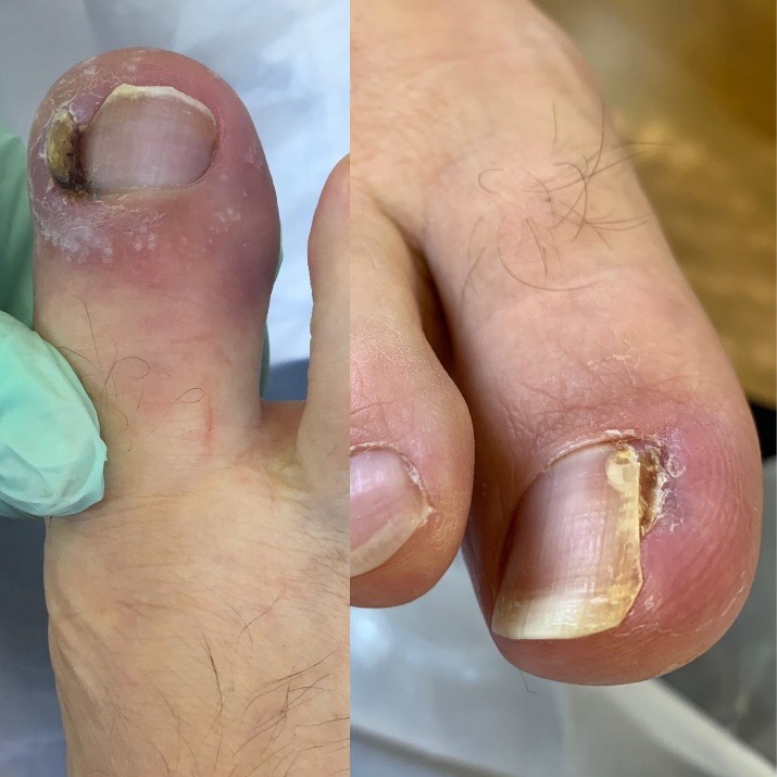 A new and simple suturing technique applied after surgery to correct ingrown  toenails may improve clinical outcomes: A randomized controlled trial -  ScienceDirect